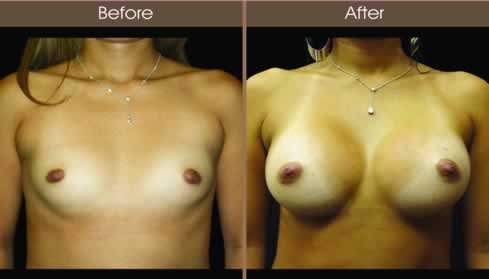 20122210141041_breastaug_13_front